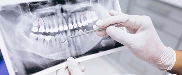 Digitalno snimanje zuba - rendgen zuba