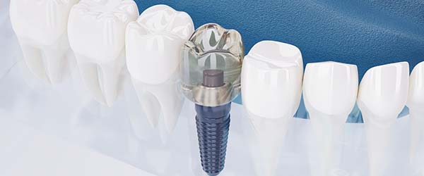 Nadogradnja zuba, implanti, protetika